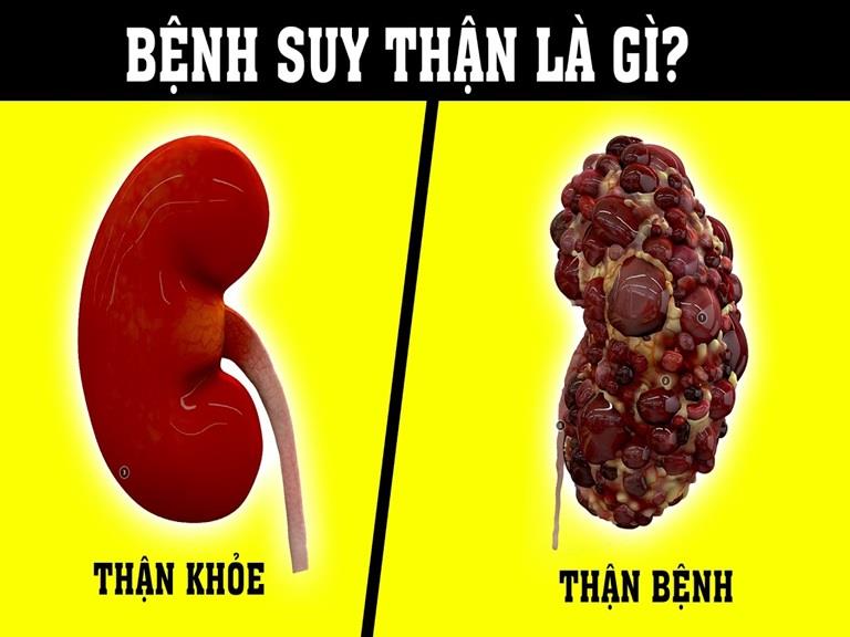SUY THẬN MÃN CÓ THỂ DẪN ĐẾN UNG THƯ