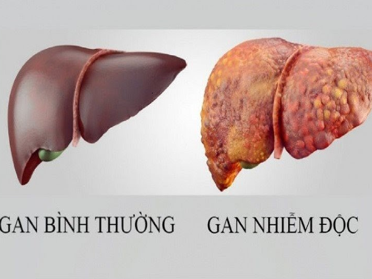 THẢI ĐỘC GAN ĐƠN GIẢN DỄ ÁP DỤNG