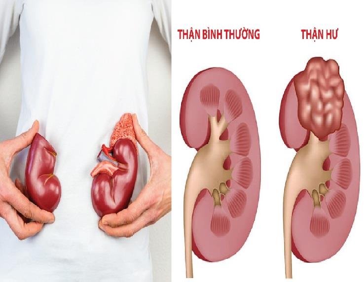 THẢI ĐỘC CHO THẬN ĐƠN GIẢN DỄ ÁP DỤNG