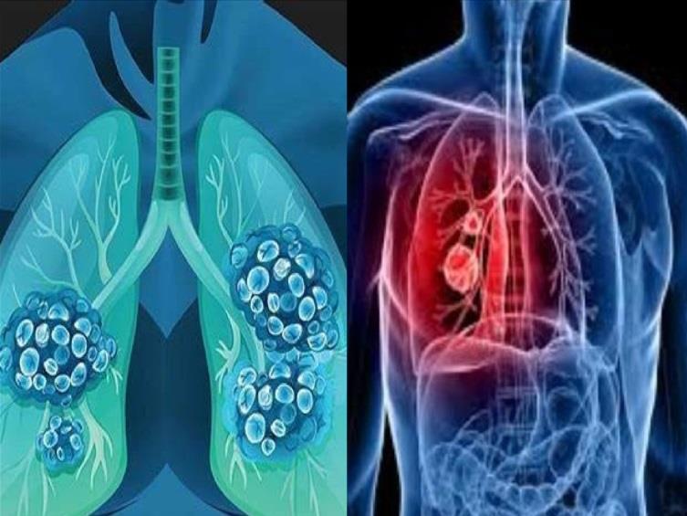 TẠI SAO UNG THƯ PHỔI LẠI NGUY HIỂM NHẤT?