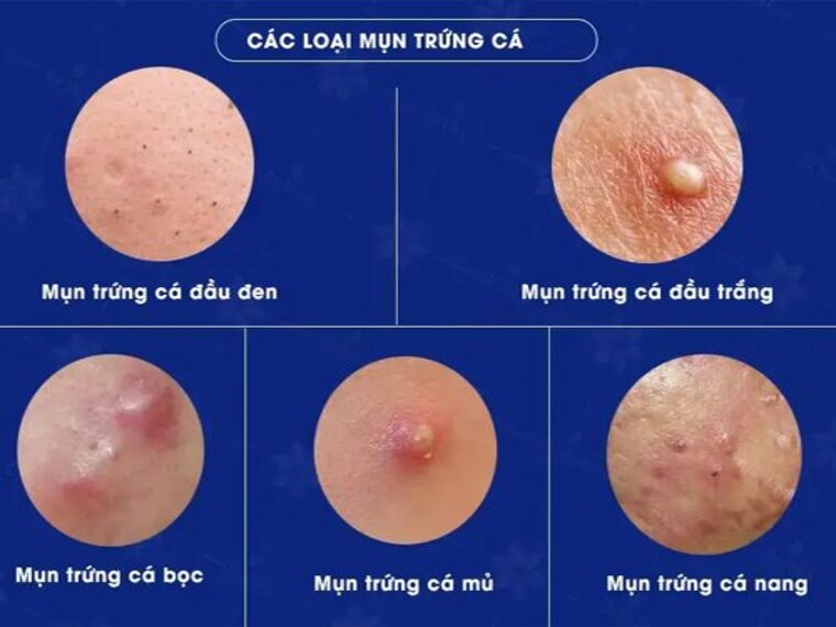 CÁC LOẠI MỤN THƯỜNG GẶP VÀ NHỮNG YẾU TỐ LIÊN QUAN ĐẾN MỤN