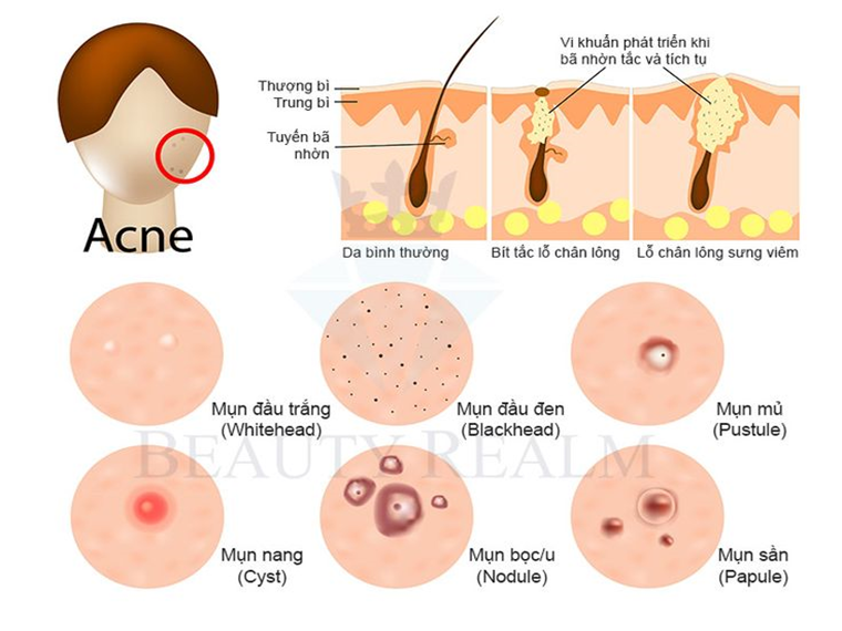 DA MẶT NỔI MỤN – VÌ SAO ĐIỀU TRỊ ĐÔNG Y HIỆU QUẢ CAO, AN TOÀN TUYỆT ĐỐI