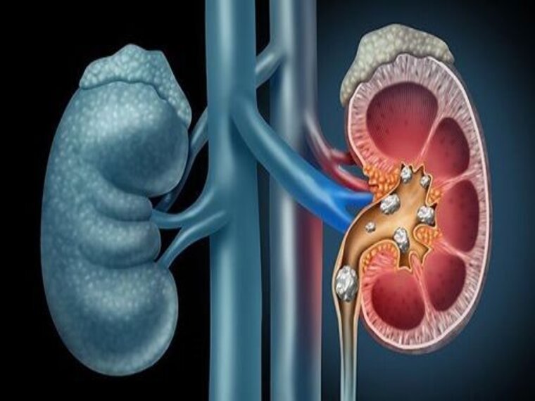 TÁN SỎI THẬN VÀ NHỮNG BIẾN CHỨNG THƯỜNG GẶP