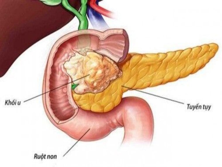 NHỮNG ĐIỀU CẦN BIẾT VỀ UNG THƯ TỤY
