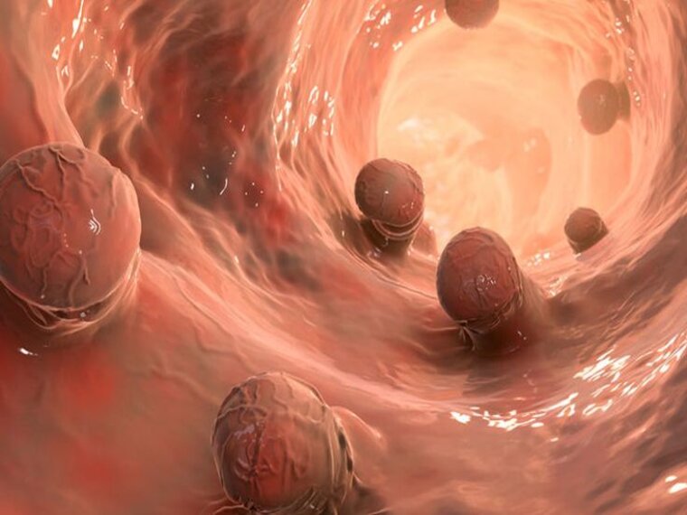 ĐIỀU TRỊ LOẠI BỎ POLYP BẰNG PHẪU THUẬT NỘI SOI THƯỜNG HAY TÁI PHÁT
