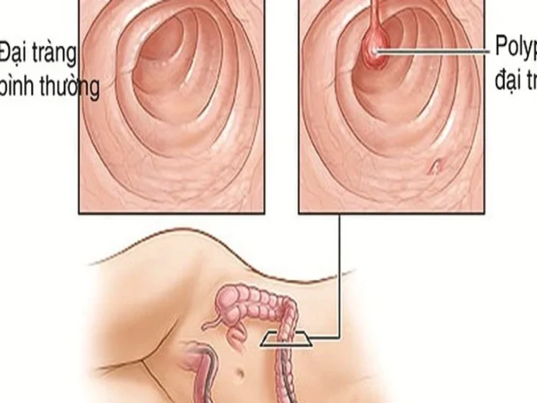 NHỮNG BỆNH LÝ DỄ DẪN ĐẾN UNG THƯ ĐẠI TRÀNG