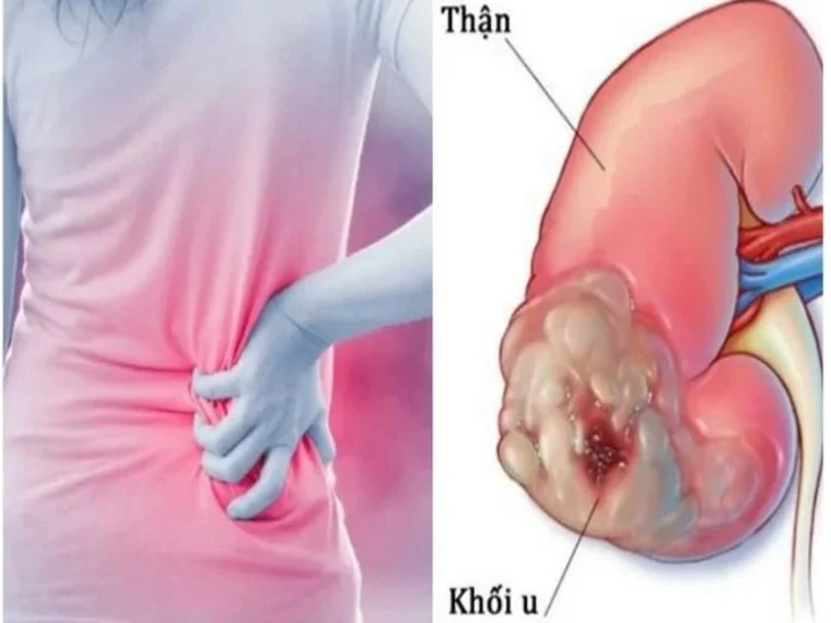 SỰ NGUY HIỂM CỦA U THẬN