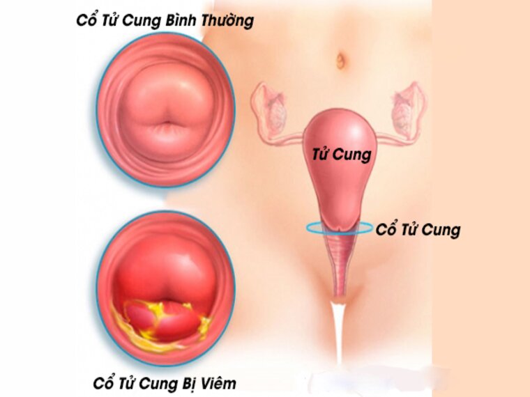 NGUY HIỂM KHÔNG NGỜ TỚI KHI BỊ MẮC VIÊM CỔ TỬ CUNG