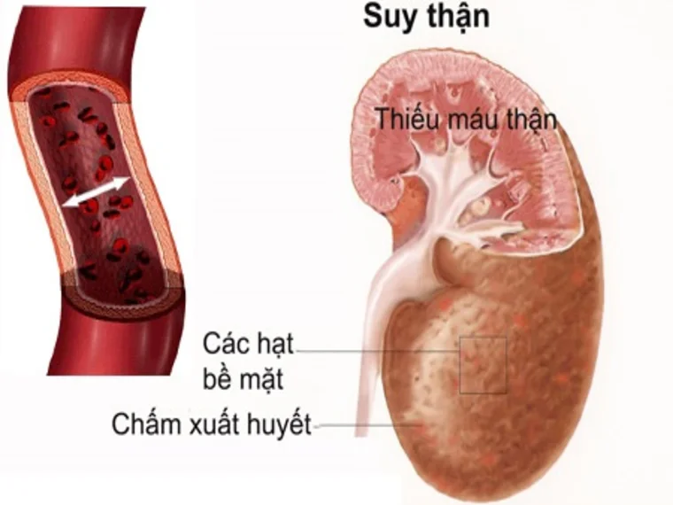 ĐÃ ĐỂ SUY THẬN MÃN LÀ KHÔNG THỂ PHỤC HỒI