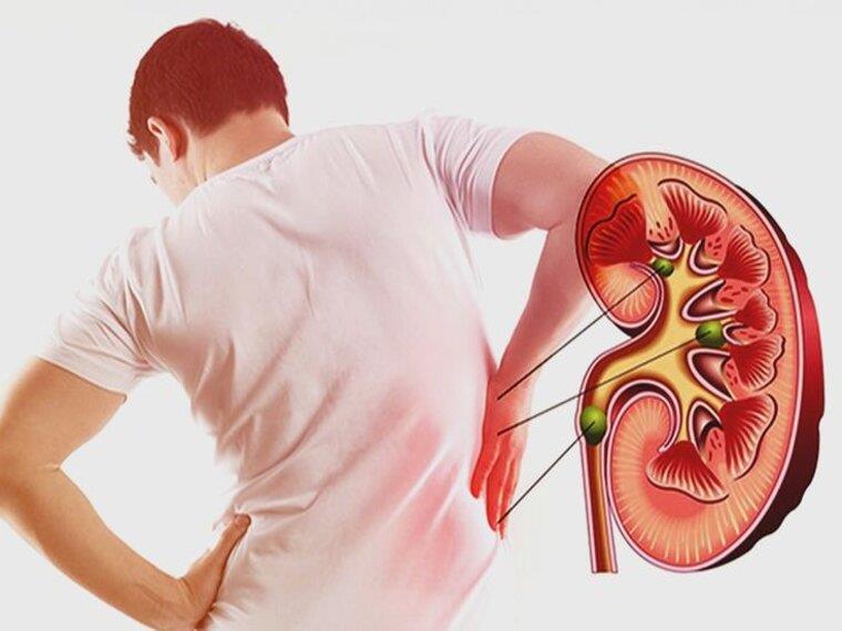 SỎI THẬN ĐỂ LÂU NGÀY DỄ THÀNH UNG THƯ