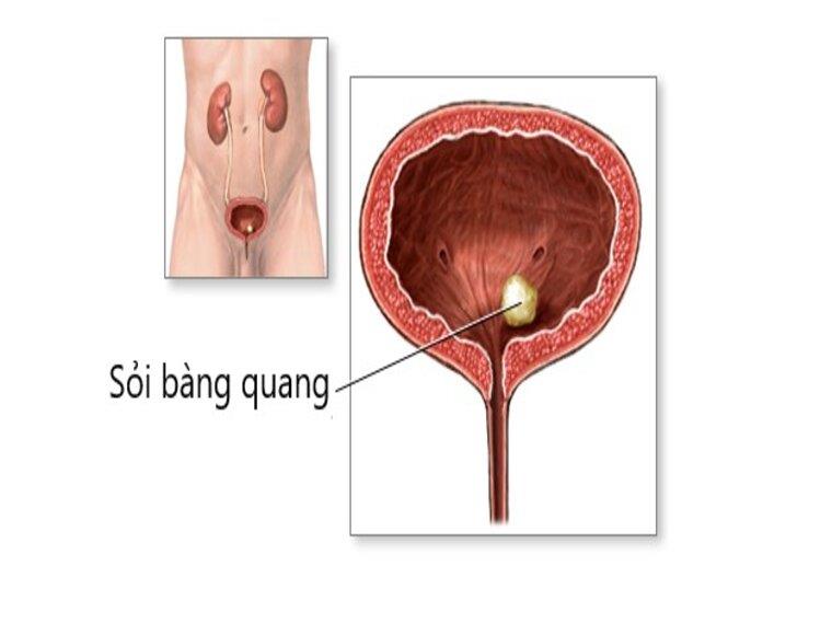 SỎI BÀNG QUANG