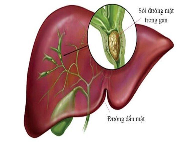 SỎI GAN – NGUYÊN NHÂN VÀ TRIỆU CHỨNG