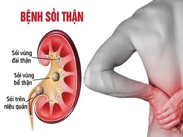 CHÚNG TA CÙNG TÌM HIỂU NHỮNG BIẾN CHỨNG KHI ĐIỀU TRỊ NGOẠI KHOA SỎI THẬN