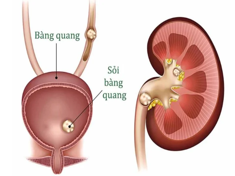 TRIỆU CHỨNG, BIỂU HIỆN CỦA SỎI BÀNG QUANG