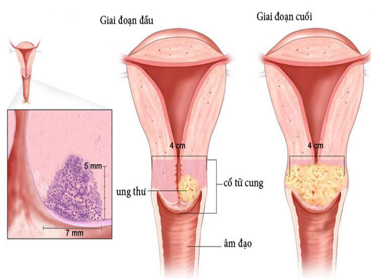 TÌM HIỂU VỀ UNG THƯ BUỒNG TRỨNG – MỘT SỐ NGUYÊN NHÂN UNG THƯ BUỒNG TRỨNG VÀ NHỮNG DẤU HIỆU CẦN CHÚ Ý