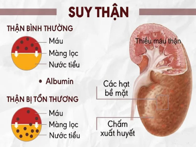 SUY THẬN MÃN CÓ THỂ DẪN ĐẾN UNG THƯ