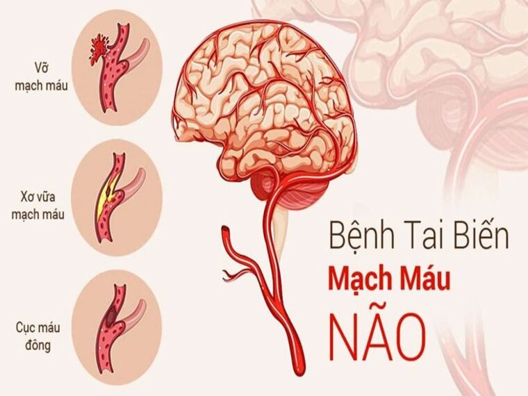 PHỤC HỒI CHỨC NĂNG SAU TAI BIẾN