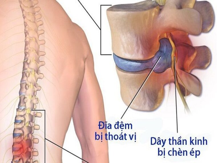 NGUYÊN NHÂN, TRIỆU CHỨNG BỆNH THOÁT VỊ ĐĨA ĐỆM