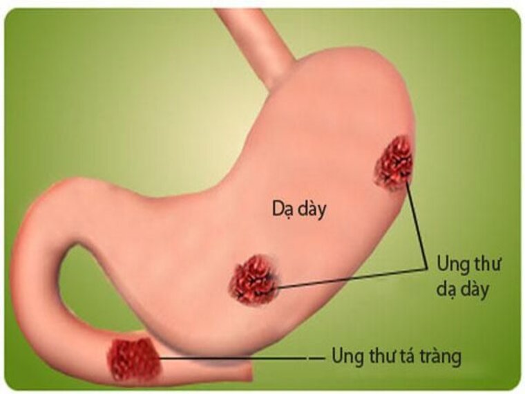 PHƯƠNG PHÁP ĐIỀU TRỊ UNG THƯ DẠ DÀY HIỆU QUẢ HIỆN NAY