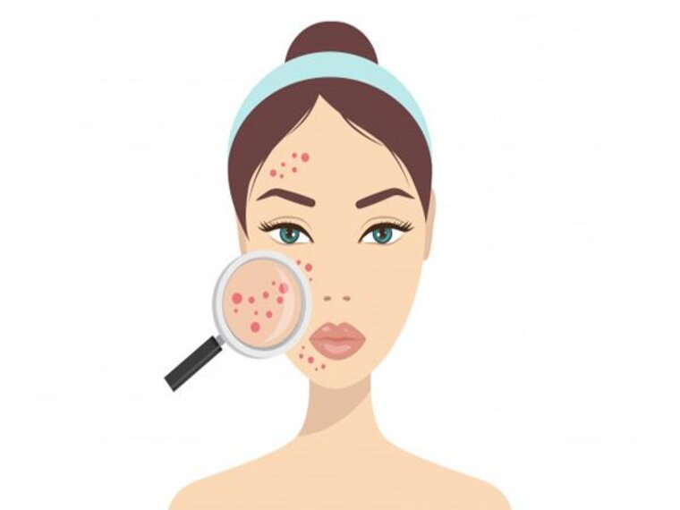 ĐỘC TỐ GÂY NỔI MỤN