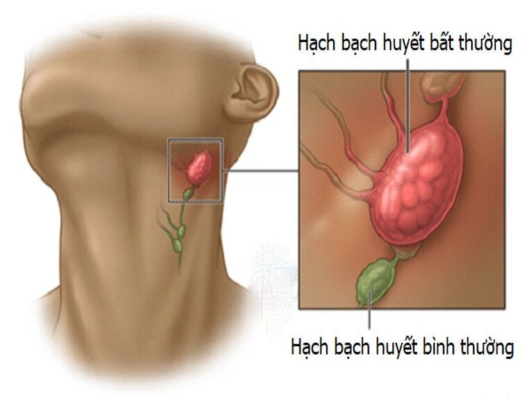 UNG THƯ HẠCH BẠCH HUYẾT