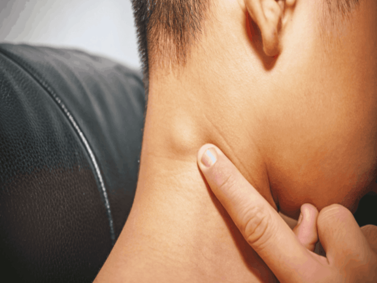 CÁC TRIỆU CHỨNG CỦA UNG THƯ HẠCH