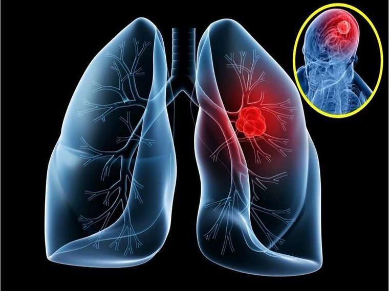 LÝ DO UNG THƯ PHỔI LẠI NGUY HIỂM NHẤT