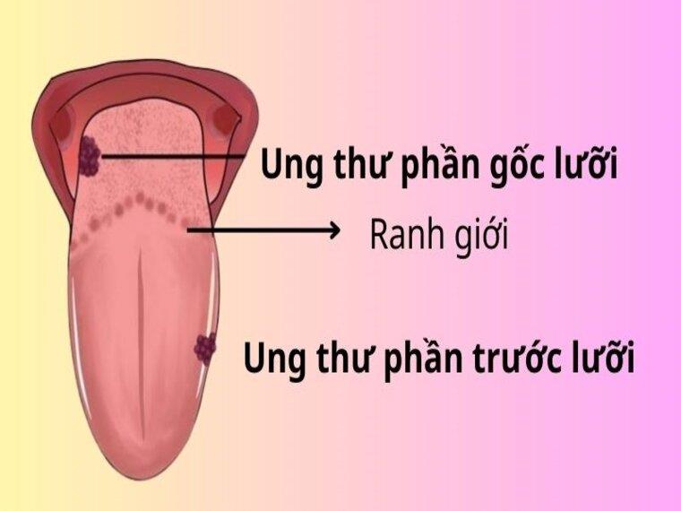 NGUYÊN NHÂN TRIỆU CHỨNG BỆNH UNG THƯ LƯỠI