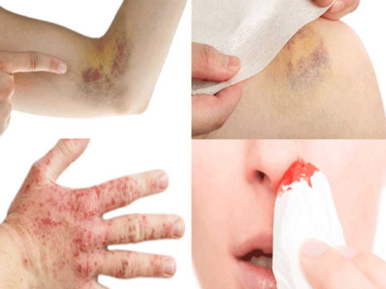 TRIỆU CHỨNG CỦA BỆNH UNG THƯ MÁU
