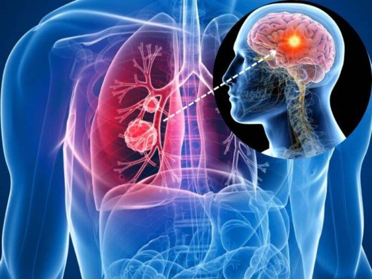 TỶ LỆ SỐNG CỦA NGƯỜI UNG THƯ PHỔI DI CĂN NÃO