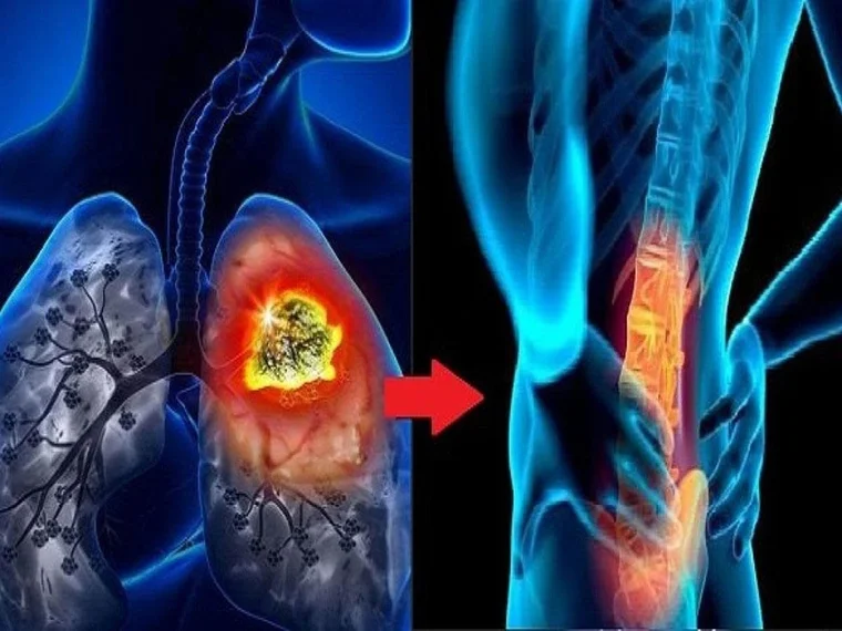 TỶ LỆ SỐNG CỦA NGƯỜI UNG THƯ PHỔI DI CĂN XƯƠNG