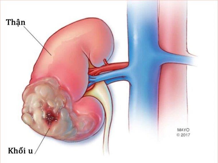 SỰ NGUY HIỂM CỦA U THẬN