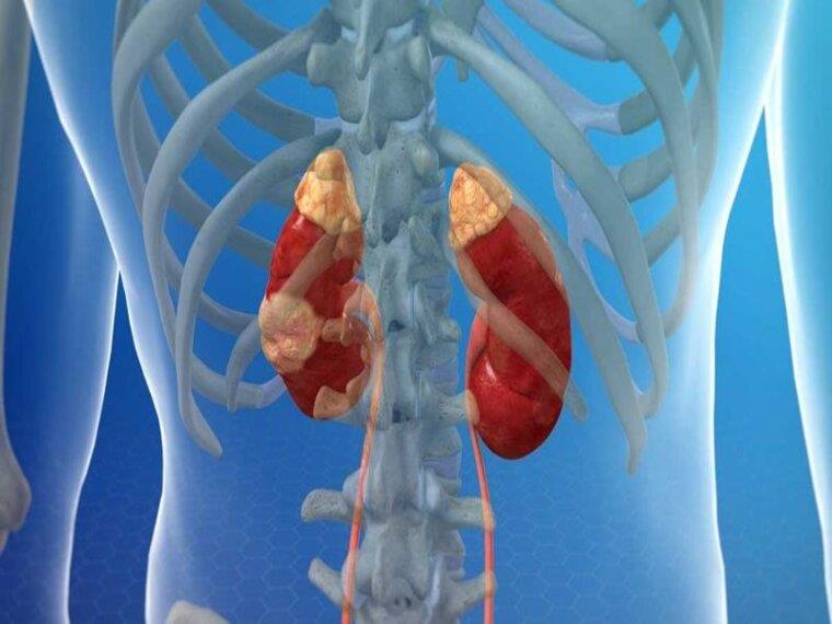 CÁC GIAI ĐOẠN CỦA UNG THƯ THẬN