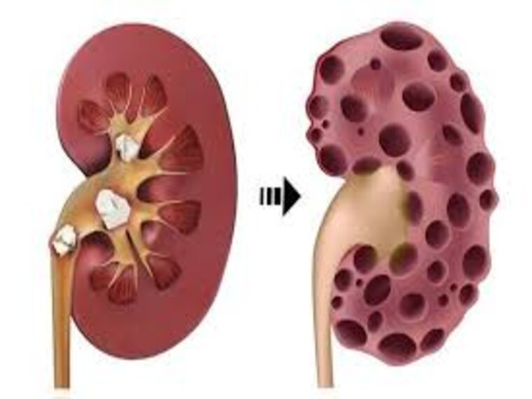 SUY THẬN MÃN CÓ THỂ DẪN ĐẾN UNG THƯ