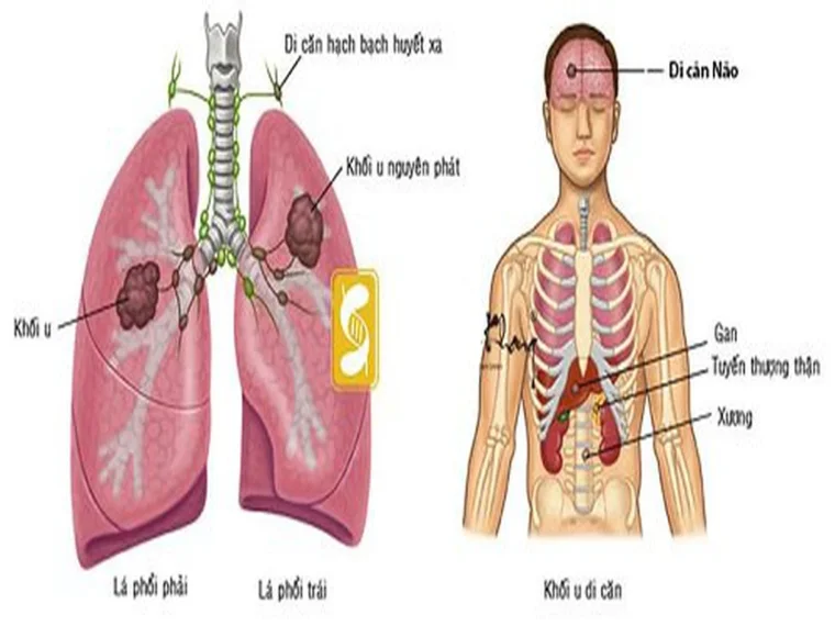 DẤU HIỆU UNG THƯ PHỔI DI CĂN