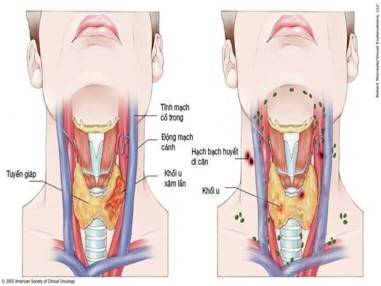 TÁC DỤNG PHỤ CỦA HÓA TRỊ LIỆU UNG THƯ VÒM HỌNG