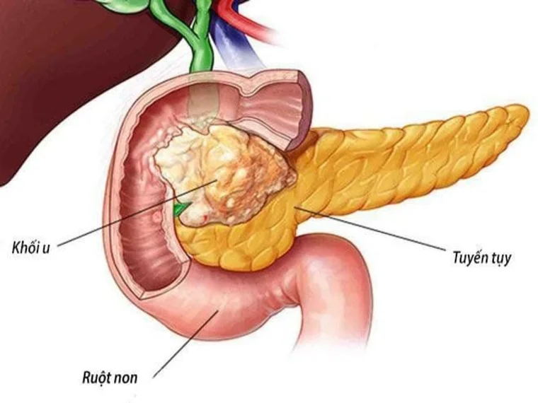 ĐIỀU TRỊ UNG THƯ TỤY – ĐỪNG ĐỨNG Ở NGÃ 3 ĐƯỜNG