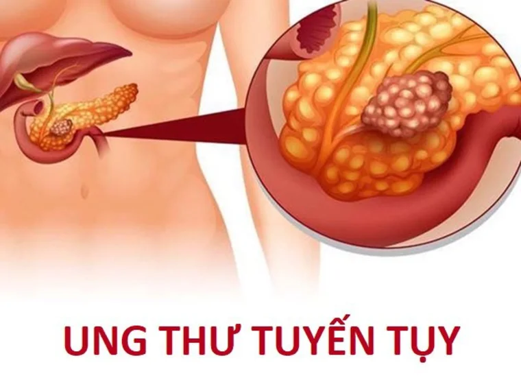 MỨC ĐỘ VÀ CÁC GIAI ĐOẠN UNG THƯ TUYẾN TỤY