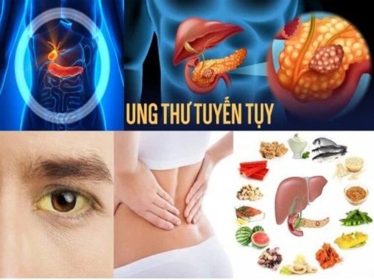 NHỮNG ĐIỀU CẦN BIẾT VỀ UNG THƯ TỤY
