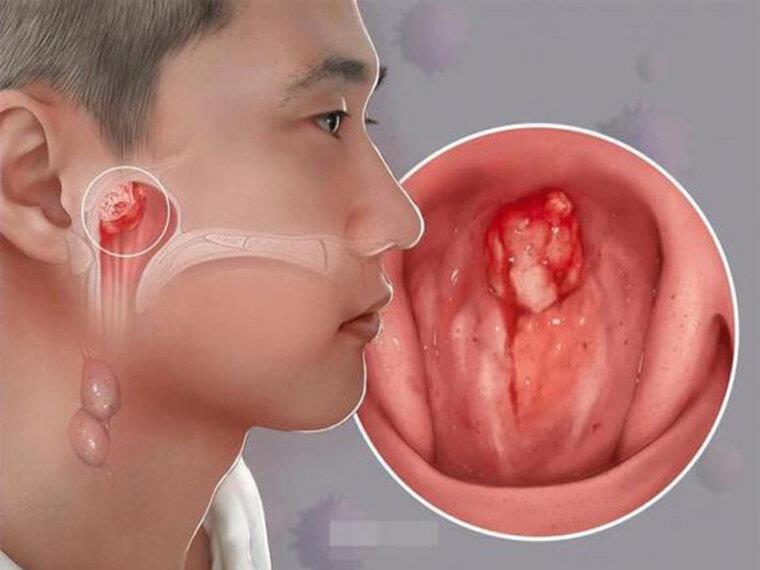 NHỮNG DẤU HIỆU UNG THƯ VÒM HỌNG