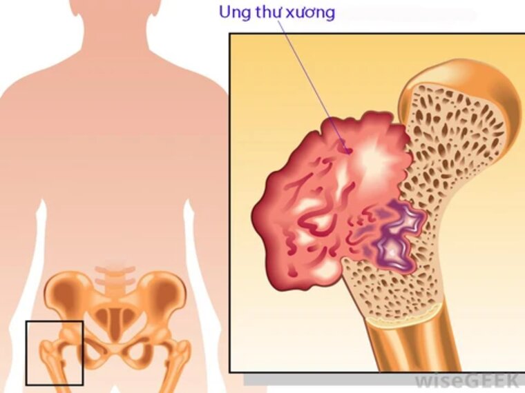 UNG THƯ XƯƠNG DI CĂN