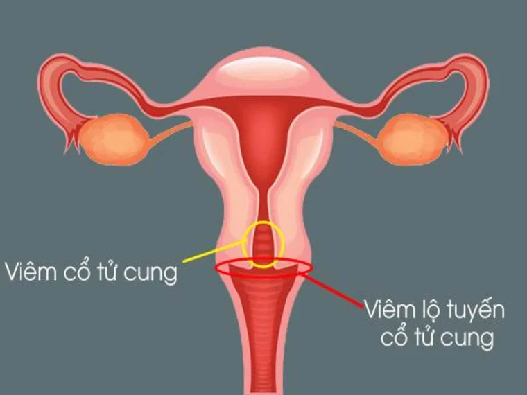 VIÊM LỘ TUYẾN CỔ TỬ CUNG