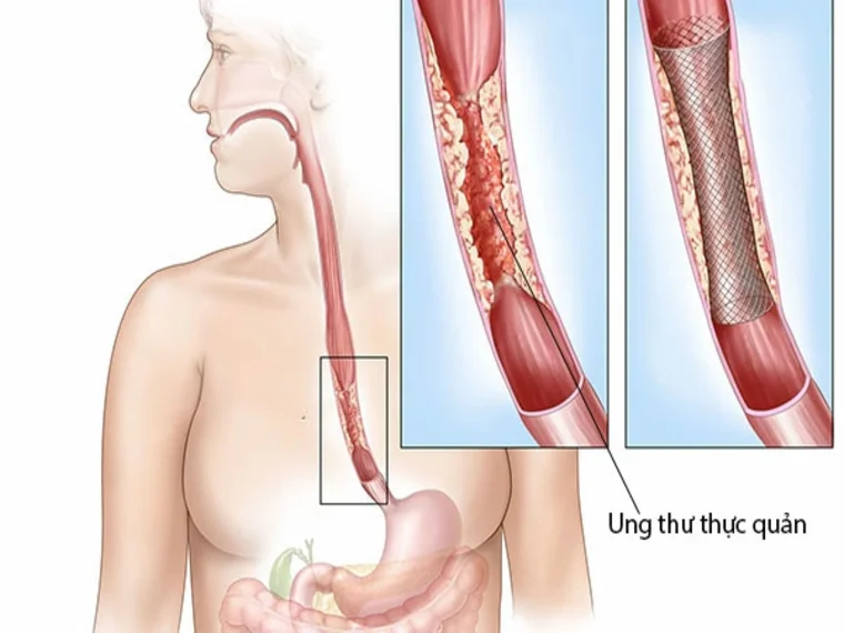 NHỮNG TRIỆU CHỨNG VÀ CHẨN ĐOÁN BỆNH UNG THƯ THỰC QUẢN