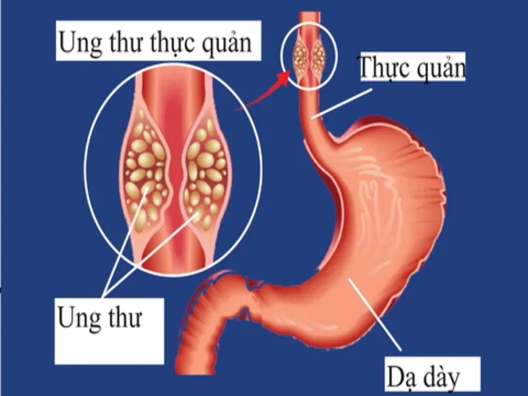 UNG THƯ THỰC QUẢN – NGUY HIỂM TIỀM ẨN TỪ TRÀO NGƯỢC DẠ DÀY