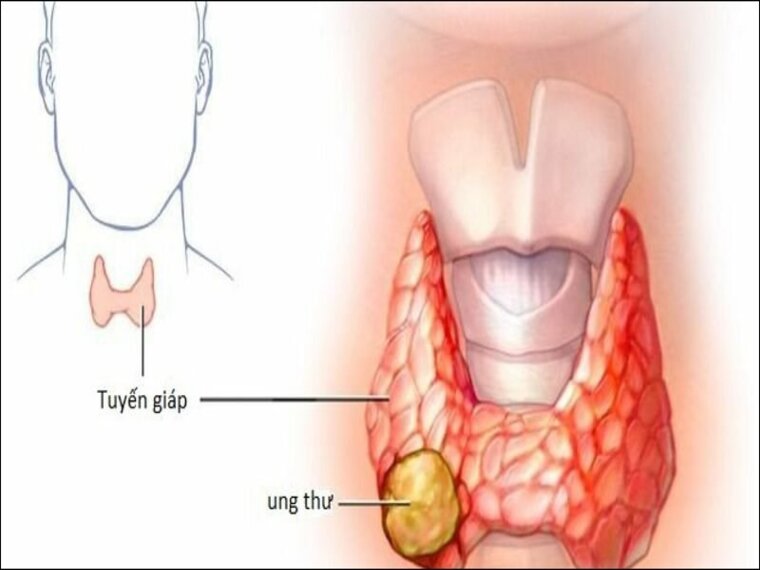 UNG THƯ TUYẾN GIÁP KHÔNG NHẤT THIẾT PHẢI MỔ Ở MỘT SỐ TRƯỜNG HỢP