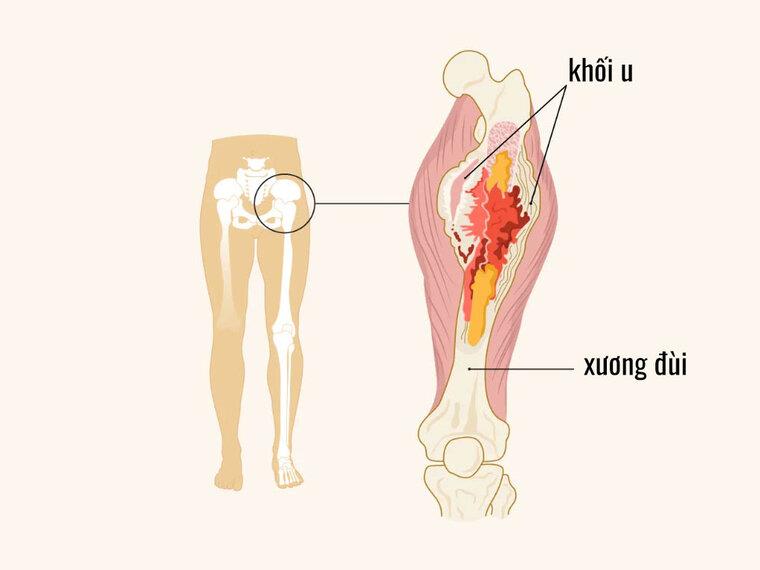 UNG THƯ XƯƠNG SỐNG ĐƯỢC BAO LÂU?