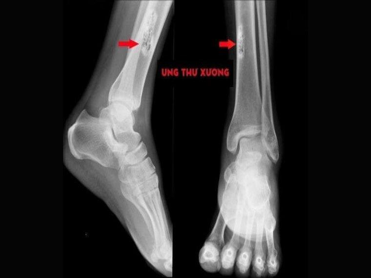 ĐIỀU TRỊ UNG THƯ XƯƠNG ĐẠT HIỆU QUẢ CAO NHẤT